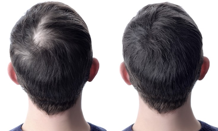 Before and after PRP treatment for hair loss